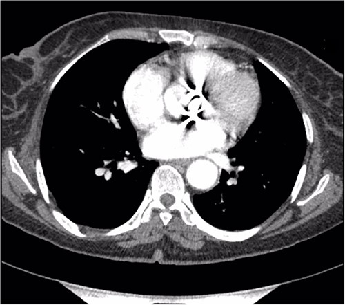 Preoperative CT demonstrating a previous aortic mechanical valve prosthesis.