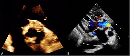 (A) Post operative TTE demonstrating a bioprosthetic valve in proper position. (B) Normal functioning bioprosthetic aortic valve with no signs of stenosis or regurgitation.
