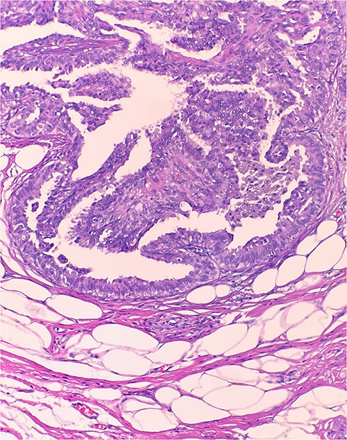 Microscopic examination reveals arborizing fibrovascular cores lined by outer layer of luminal cells and an inner layer of myoepithelial cells (H&E 20×).