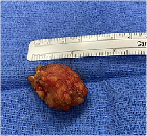 Specimen received in lab was a relatively well-defined nodular tissue (gross photo).