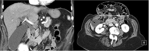 Contrast-enhanced computed tomography: a coronal image revealing two iso-attenuating filling defects in the distal bile duct causing obstruction (black arrows) (A) and a subcostal axial slice of a giant incisional hernia (horizontal distance 14 cm, white line, GB, black arrow) (B)