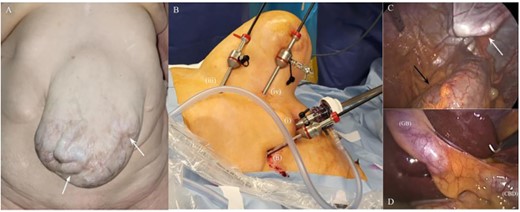 Intraoperative images. Giant incisional hernia with peristaltic movements in a loop of small intestine (white arrows) (A); trocar placement in relation to the incisional hernia: first 10-mm trocar in the midclavicular line (i), 5-mm trocar subcostally in the anterior axillary line (ii), 5-mm assistant-port in the epigastrium (iii) and 5-mm working-port parallel to the subcostal plane in tangential position to the right border of the hernia (iv) (B); laparoscopic view of the hernia sac pushed against surgeon’s finger (white arrow) and the transverse colon below (black arrow) (C); laparoscopic view of the GB and the CBD (D)