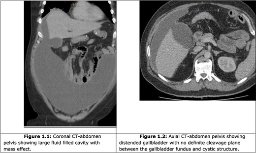 CT abdomen and pelvis.