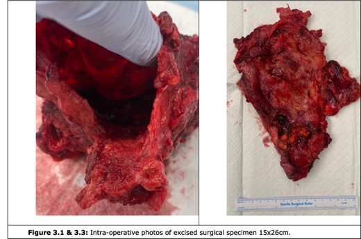 Intra-operative photos of excised cyst.