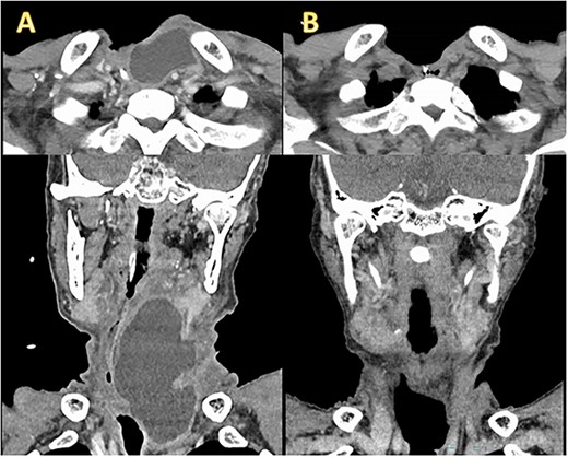 Enhanced CT before and after OK432 injection. (A) Before OK432 injection. Cervical CT shows a chylous leakage in the left supraclavicular fossa. (B) After two cycles of OK4432 injection. The chylous leakage completely disappeared after OK432 sclerotherapy.