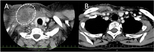 Enhanced CT before and after OK432 injection. (A) Before OK432 injection. The lymph (dashed circle) is retained in the right supraclavicular fossa. (B) After injection. The lymphatic leakage disappeared after OK432 sclerotherapy.