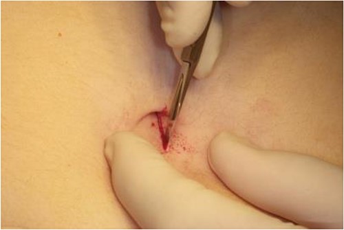 Image of incision site for surgical technique.