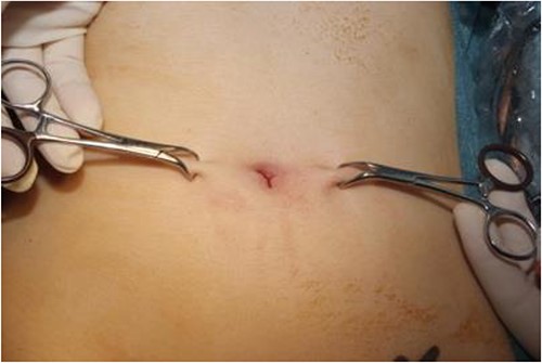 Image of towel clips elevating skin.