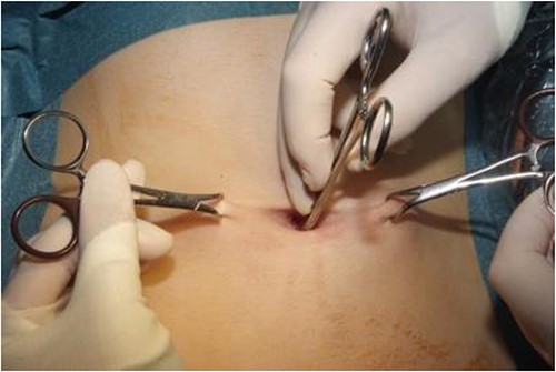 Image of the depth of skin measurement with artery forceps.