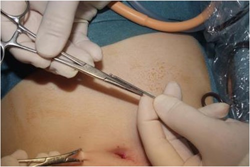 Image of the estimation of this depth with the Veress needle.