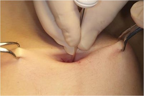 Image of the insertion of the Veress needle.