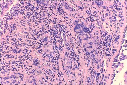 Microscopic examination reveals clusters of tumor cells below the endobronchial lining. Hematoxylin and Eosin (H&E) 40×.