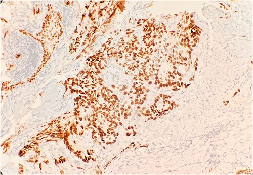 Tumor cells are positive for TTF1 by immunohistochemical stain (IHC) 20×.