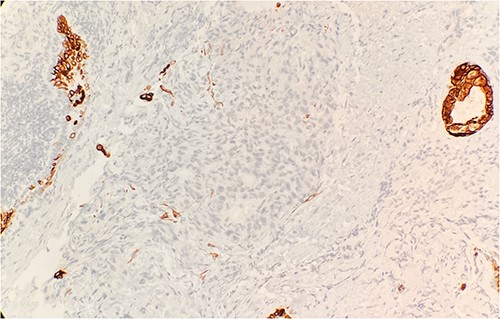 Tumor cells are negative for CK7 by immunohistochemical stain IHC 20×.