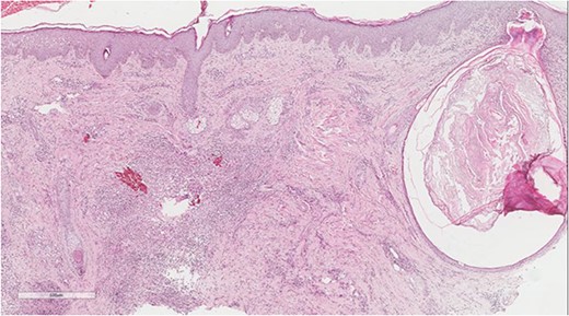 Dilated hair follicle with perifollicular inflammation and adjacent foreign body giant cell reaction secondary to ruptured dilated hair follicle in a background of dermal fibrosis.