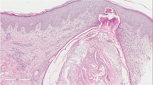 Perifollicular and intrafollicular neutrophilic infiltrate.