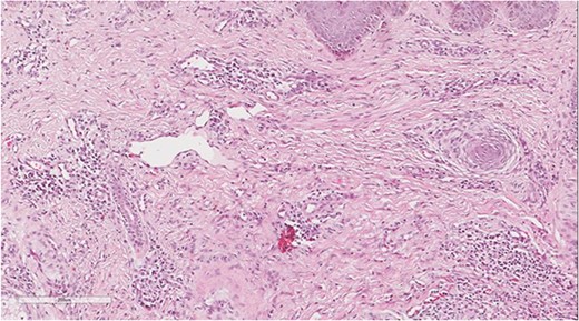 Perivascular lymphoplasmacytic infiltrate that is a common finding in HS.