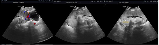 Ultrasound showing intra-placental lacunae (white arrows) as well as placental tissue protrusion beyond the uterine myometrium, as well as urinary bladder wall discontinuity and the extension of Doppler vascularity between serosa and the bladder (Fig. 1).