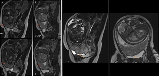 (a)–(d) Sagittal sequences showing dark intra-placental bands (arrows) in low signal in HASTE sequences and in high signal on truFISP. (e) Sagittal HASTE and (f) coronal truFISP sequences showing myometrial thickening and discontinuity in the bladder wall as well as its invasion by the placental tissue (arrow).