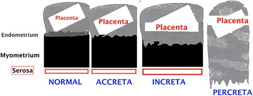 Schematic representation of the different types of placental insertion abnormalities.