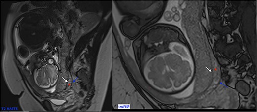 Sagittal T2 Weighted Images showing normal MRI signal of the placenta and the myometrium at the end of 2nd trimester. Note the trilaminar aspect of the myometrium: retro placental layer in hyposignal (white arrow), intermediate layer (the zone of arcuate vessels in intermediate signal red asterisk) and the external layer (the serosa) with a thin T2 hyposignal aspect (blue arrow).