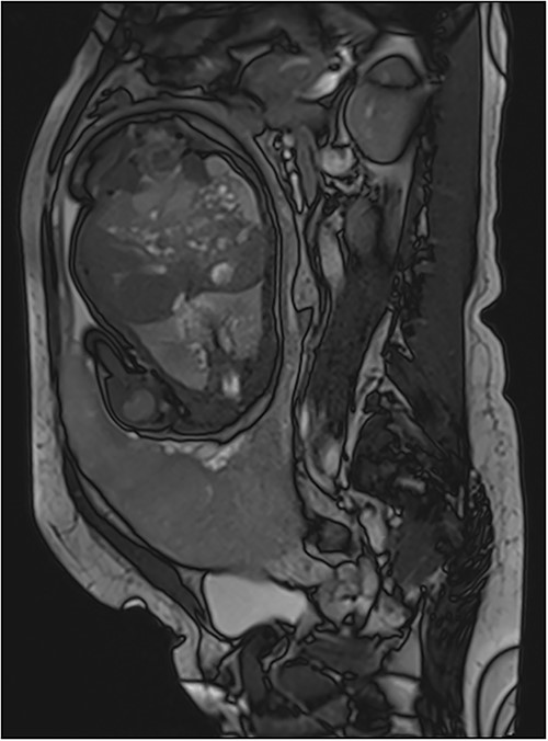 Trufisp T2 sagittal-WI of a 44-year-old patient in our department showing the invasion of the urinary bladder.