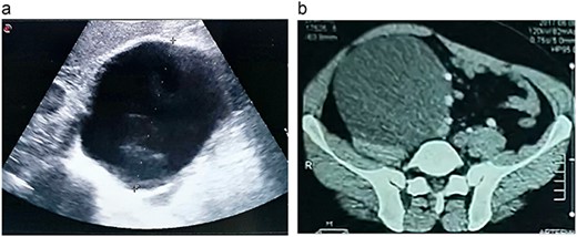 a. An US image showing a large cystic mass in the right abdomen. b. A CT scan of the abdomen showing a cystic mass of 17 × 11 × 10 cm with a fat-fluid level.