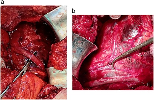 a. Isolation of the right ureter. b. Isolation of the right iliac artery.