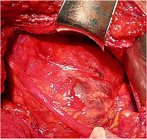 Intraoperative view of the cyst.