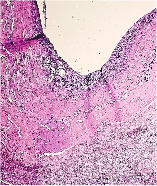 Microscopic view of the chylolymphatic cyst wall.
