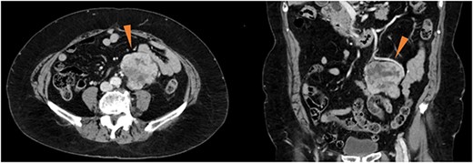 Contrast-enhanced computed tomography showing a well-defined, heterogeneously enhanced mass (red triangles) in the vicinity of the left ovarian artery and left ureter.