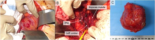 Operative pictures. (A) retroperitoneal tumor; (B) inferior mesenteric artery, iliopsoas muscle and left ureter after resection; (C) operative specimen IMA, inferior mesenteric artery.