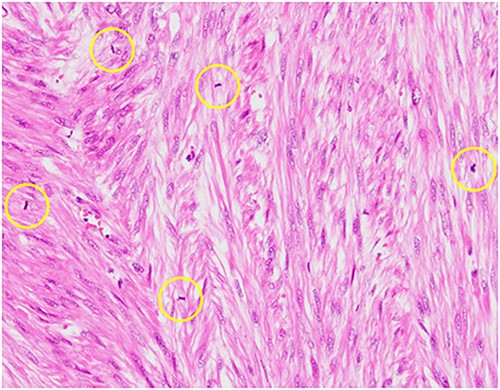 Hematoxylin–eosin staining, ×10 showing increased mitotic activity (yellow circles).