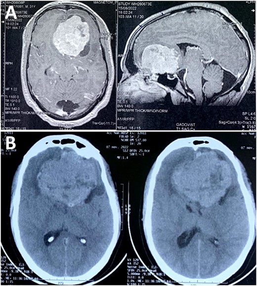 (A) MRI scan showing a skull base tumor that was hypointense on T1, and hyperintense on T2, with regular and homogeneous contrast enhancement; (B) CT scan demonstrated a rapid growth of the tumor, almost reaching double the initial volume over a 2-month period.