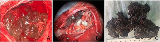 (A) Intra-operative appearance of the tumor (star); (B) aspect of dura mater after excision (star); (C) macroscopic appearance of the tumor after formalin fixation.