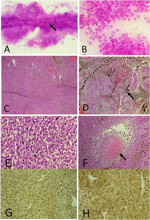 (A) Intra-operative cytological smear showing a hypercellular proliferation with pigmented deposits (arrow); (B) tumor cells were monomorphic, round and undifferentiated; (C) histologically, the tumor was composed of hypercellular sheets and spindled cells (H&E ×100); (D) many melanic deposits have been observed (arrow) (H&E ×100); (E) at high magnification, the tumor cells had an enlarged oval-shaped nuclei and prominent nucleoli (H&E ×400); (F) foci of necrosis within the tumor (arrow) (H&E ×200); on IHC: the tumor cells express HMB45 (G) and Melan A (H).