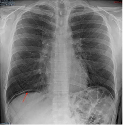 Chest X-ray.