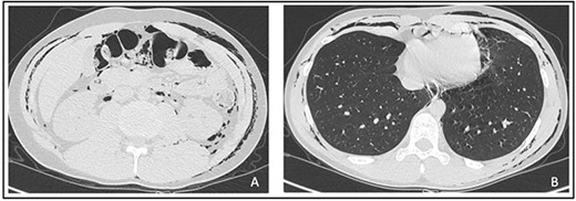 (A and B) Abdominal and thorax subcutaneous emphysema (CT).