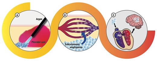 Hypotized mechanism that explains neurological symptoms of our patients: (A) the argon applicator too close to the tissue treated determined a massive passage of gas into the subcutaneous tissue; (B) argon bubbles entering the blood stream, some of them not dissolved (emboli); (C) argon emboli reaching the heart and, through PFO, the brain, resulting in the neurological symptoms described.
