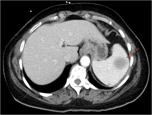 CT of the abdomen (axial section) showing an enlarged spleen with a 3.5 cm lesion.