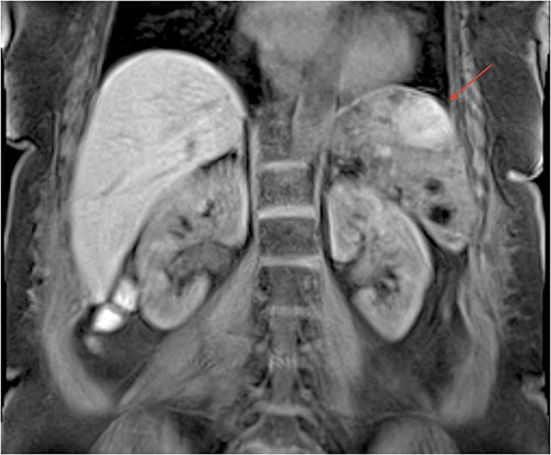 MR imaging of the abdomen (coronal section) revealing an enlarged spleen with multiple lesions, the largest one with heterogeneous enhancement.