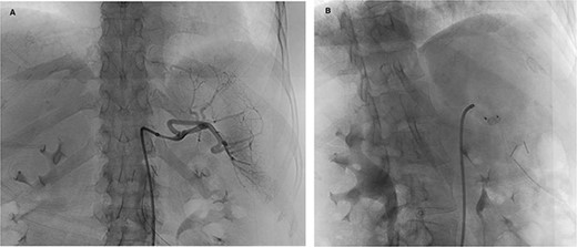 Preoperative splenic artery embolization (A: angiogram, B: post-plug deployment).