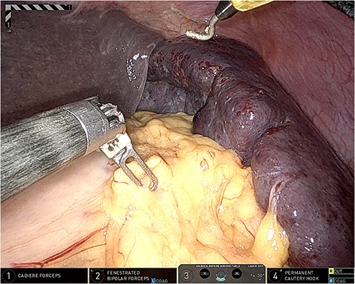 Intraoperative picture showing an enlarged and highly perfused spleen.