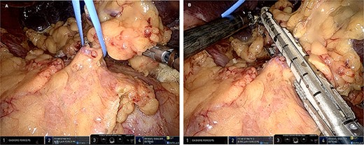 (A) Intraoperative picture displaying the splenic main pedicle surrounded by a vessel loop; (B) intraoperative picture unveiling the division of the splenic main pedicle using a vascular stapler.
