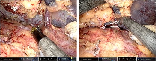 (A) Intraoperative picture exhibiting the dissection of a spontaneous splenorenal shunt; (B) intraoperative picture exhibiting the division of the spontaneous splenorenal shunt division between clips.