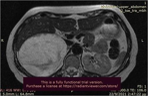 MRI scan depicted a 16 × 15 × 6 cm right adrenal mass with characteristics suggestive of a myelolipoma (transverse plane).