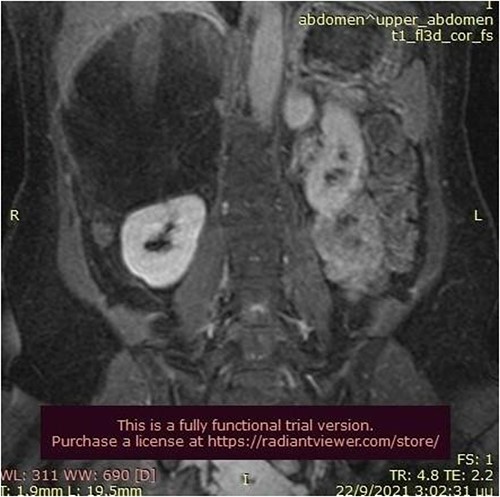 Abdominal MRI scan (frontal plane).