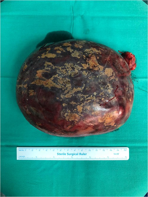 The resected specimen.