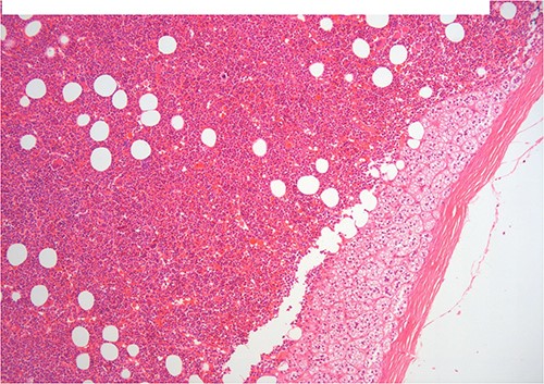 H–E ×200 hematopoietic elements including megakaryocytes with some lipocytes. Above there is a rim of compressed adrenal cortical tissue and fibrous capsule of the adrenal.