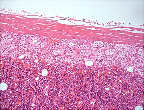 Same histologic features in higher fields.